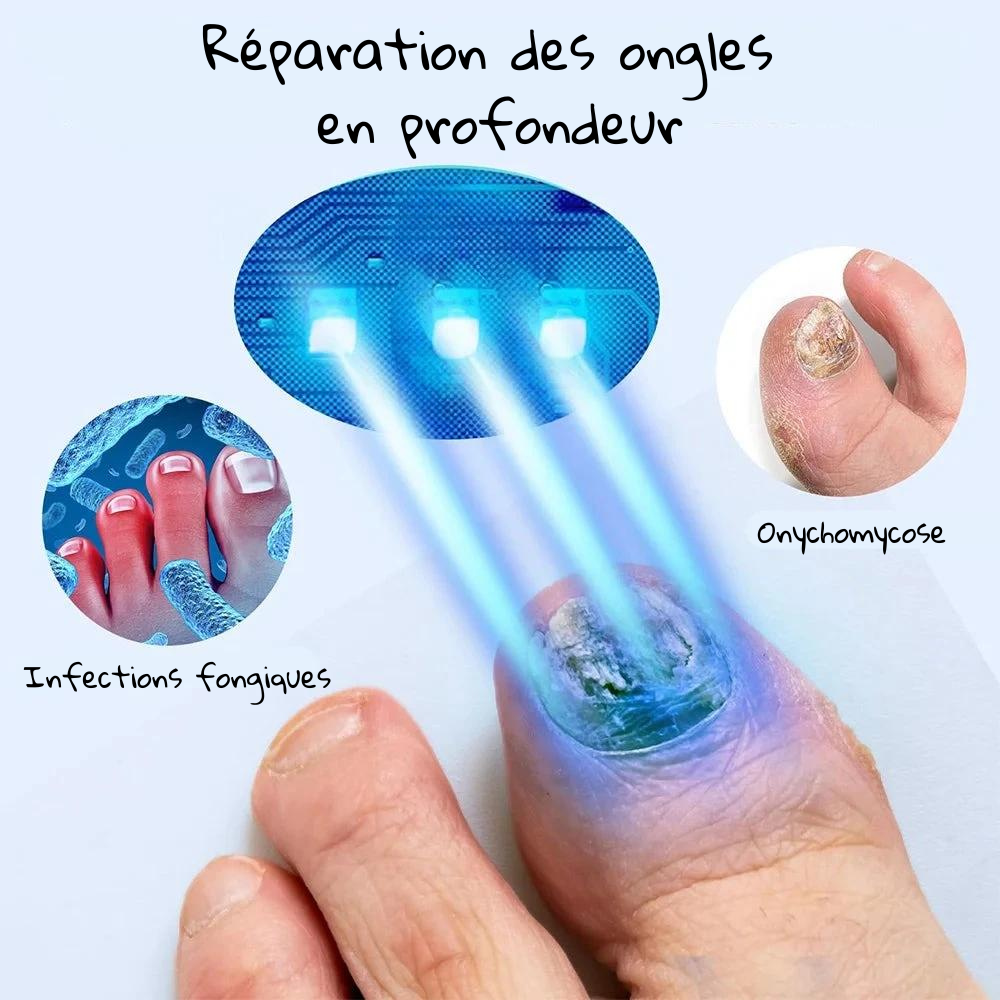 Appareil de traitement rapide au laser pour ongles - Huile réparatrice OFFERTE