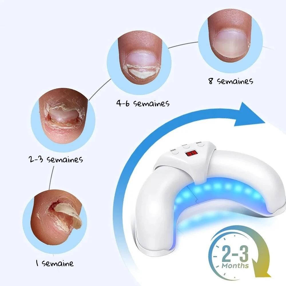 Appareil de traitement rapide au laser pour ongles - Huile réparatrice OFFERTE